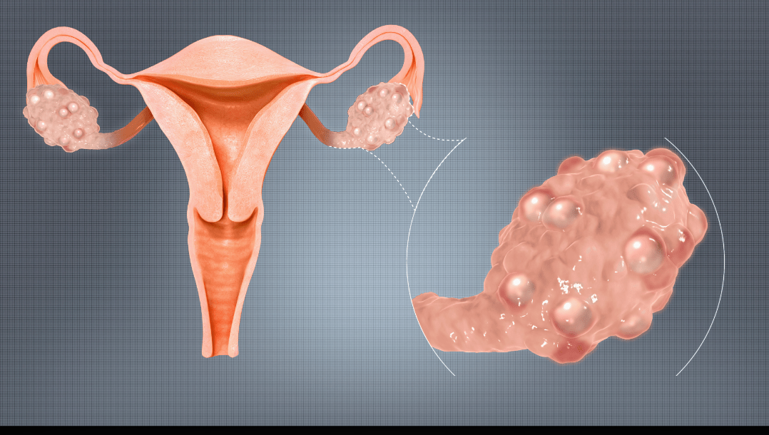 Endocrine disorders – PCOS ,thyroid problems