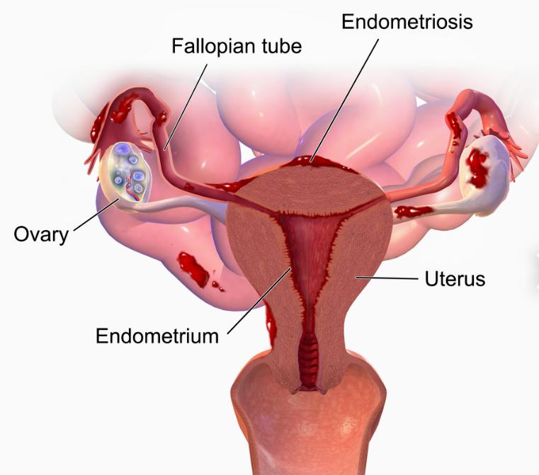Gynaecology -Fibroid, Endometriosis