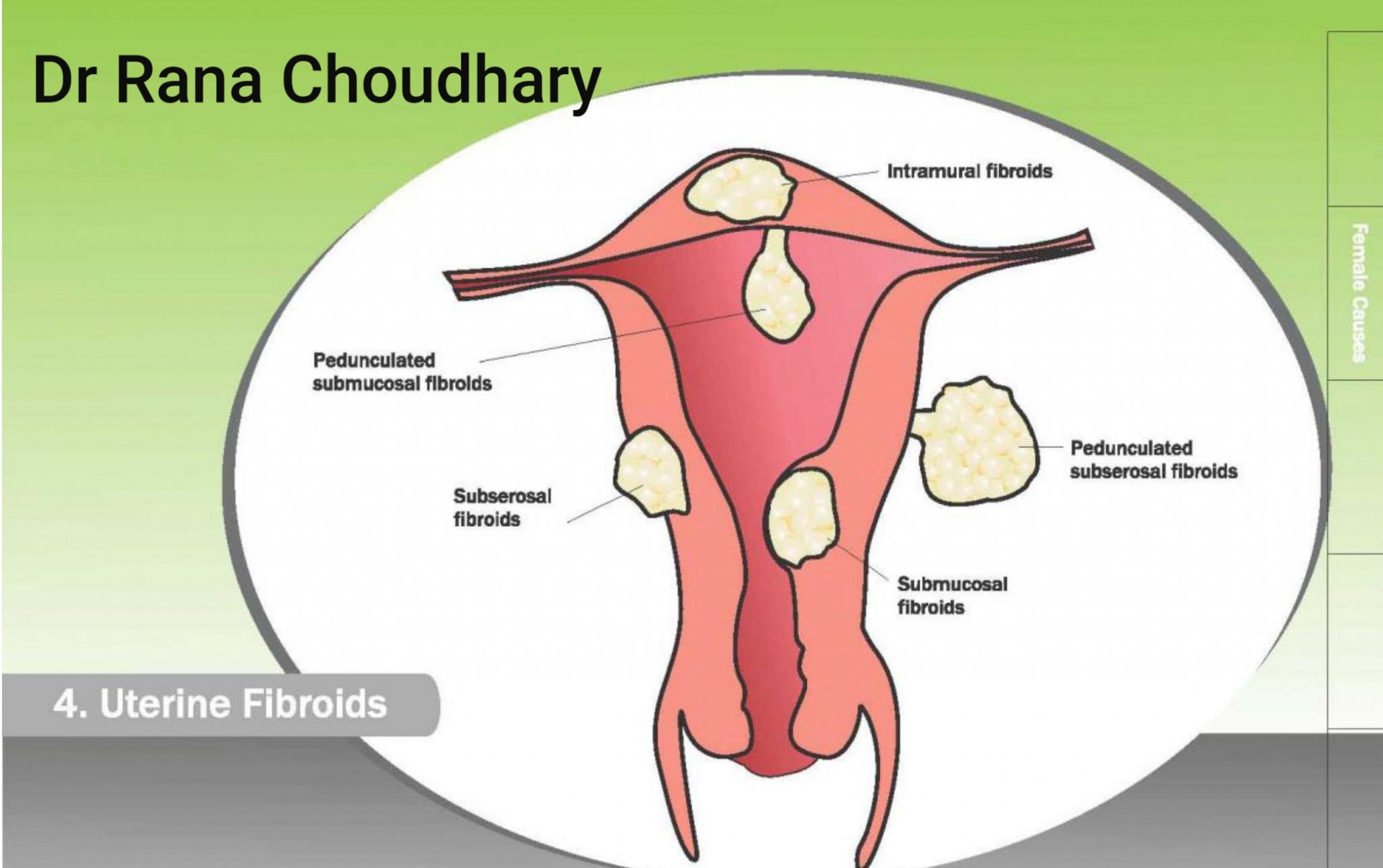 Gynaecology Fibroid Endometriosis Polyp Treatment Dr Rana Choudhary