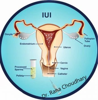 IUI (Intrauterine insemination )