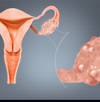 Endocrine disorders – PCOS ,thyroid problems